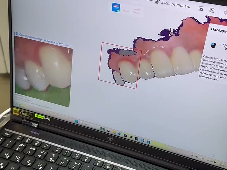3D-модель челюсти для планирования лечения элайнерами